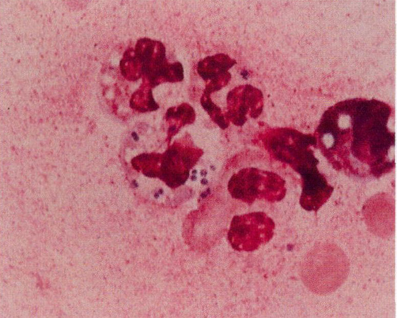 图2-43 淋病奈瑟菌感染